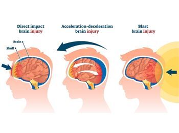 Concussion Concussion