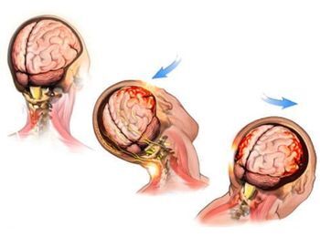 Concussion