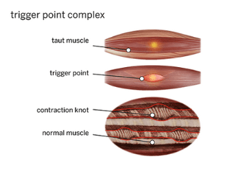 Trigger Points