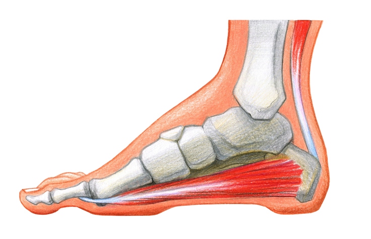 Scheme of foot with the corn and plantar callosityon Scheme of foot with the corn and plantar callosityon a white background